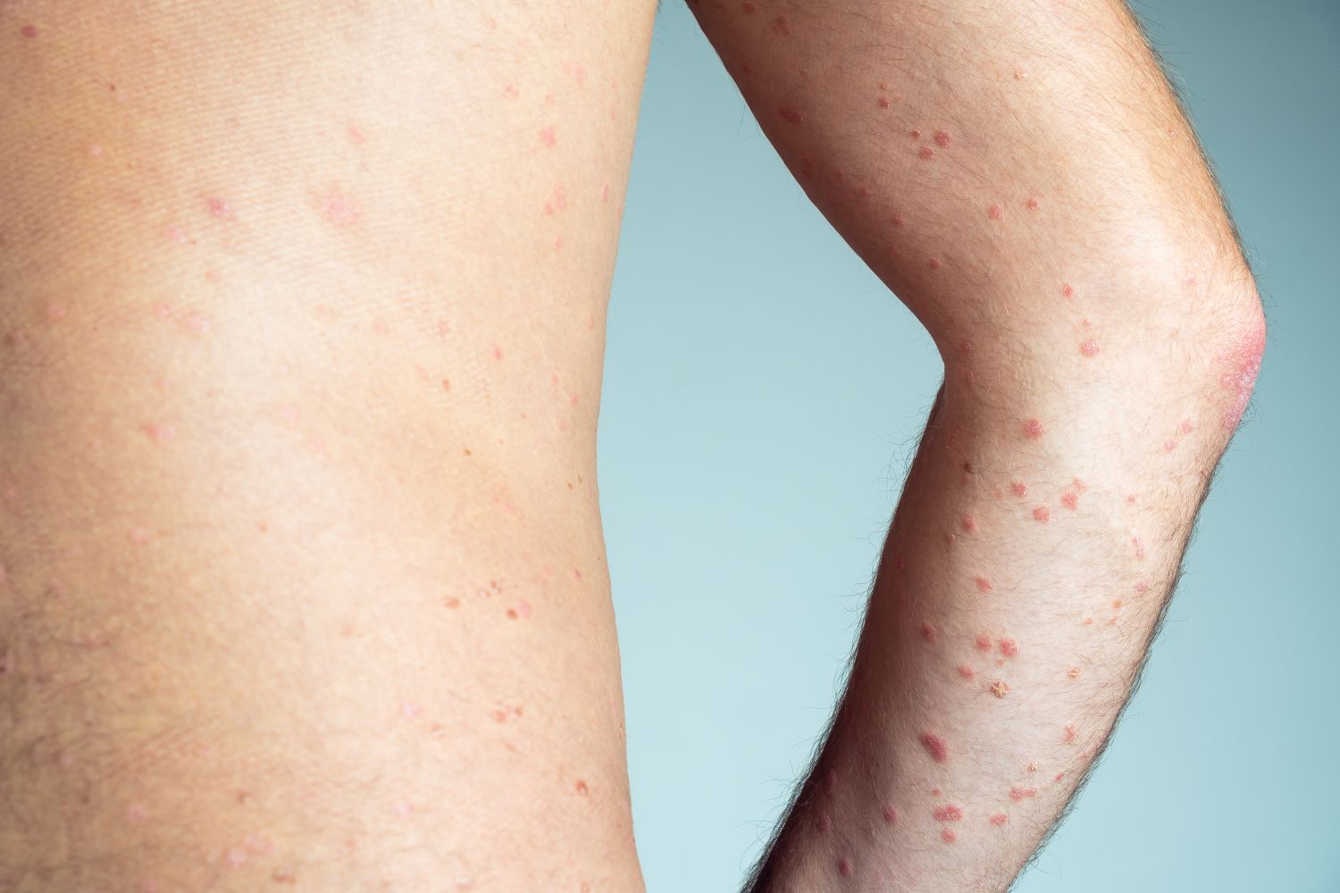 Psoriatic Arthritis Jorja Emerson Centre